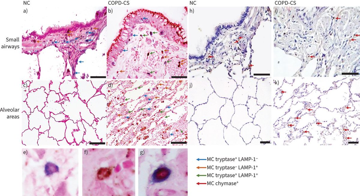 ERJOR: Mast cells in smokers and patients with small airway disease and COPD may be associated with airway wall changes and impaired lung function, indicating an active role in maintaining normal tissue homeostasis and, indirectly, in airway architecture bit.ly/3vKxxab