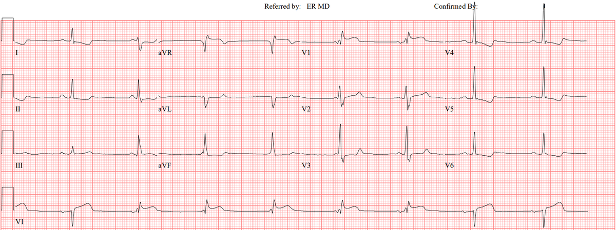 A 50-something male with chest pain. Is there OMI? And what is the rhythm? hqmeded-ecg.blogspot.com/2024/03/is-the… @willyhfrick