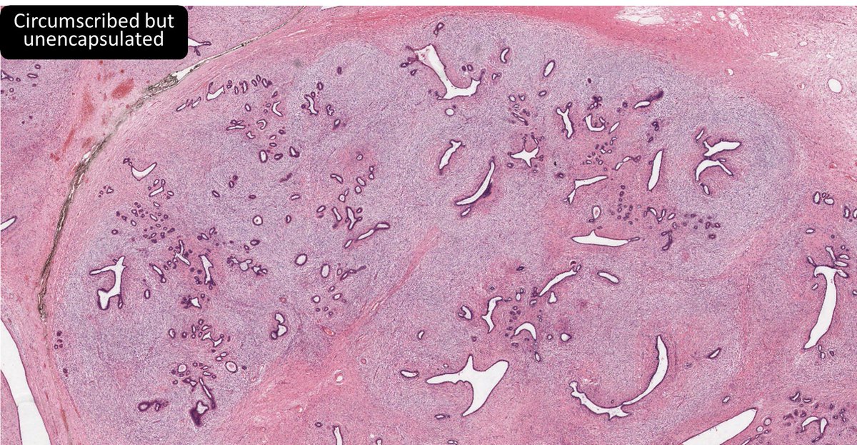 DrCycloPath's tweet photo. 18♀️
Phyllodes Tumor or Juvenile Fibroadenoma?
#BreastPath #PathTwitter #PediPath #pathresidents
🔬https://t.co/f7UBrW87eo https://t.co/JxkMdcnXZi