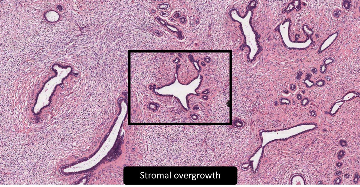 DrCycloPath's tweet photo. 18♀️
Phyllodes Tumor or Juvenile Fibroadenoma?
#BreastPath #PathTwitter #PediPath #pathresidents
🔬https://t.co/f7UBrW87eo https://t.co/JxkMdcnXZi