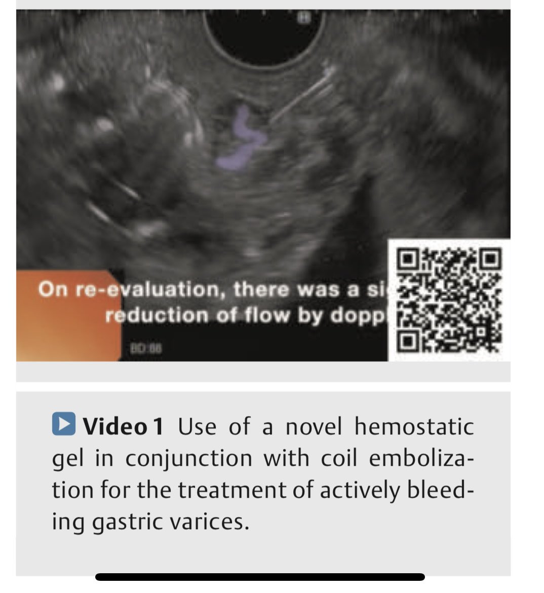 📰 Successful use of PuraStat and coils to treat actively bleeding gastric varices. Check out our video published in @ThiemeIntl with an ex vivo demonstration as well! @TrieuMD thieme-connect.de/products/ejour…