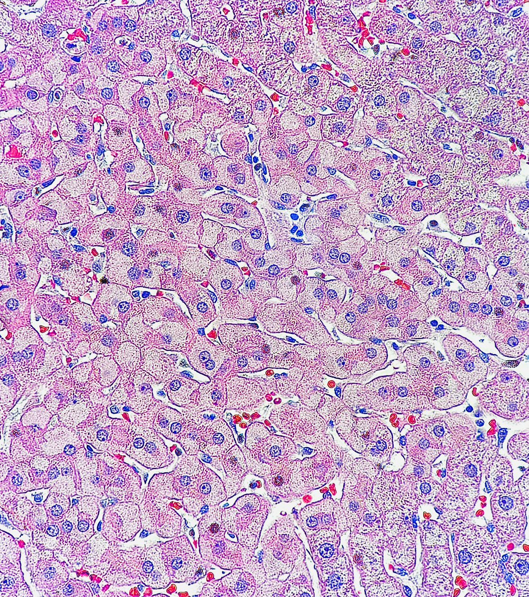 Path4People's tweet photo. I am a partially double stranded, circular DNA virus

I may chronically infect a human and lead to histologic appearance 👇 

Serology can help determine if you’ve been vaccinated against me. 

Who am I? 🤔 

#pathagonia #pathx #surgpathx #medstudentx #usmle #medicalstudent #medx https://t.co/Pfb0dpdzEO
