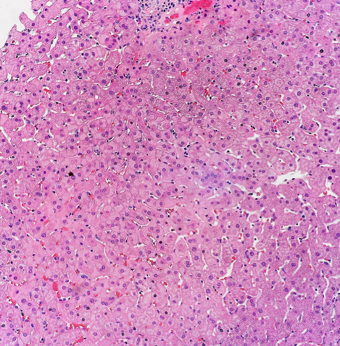 Path4People's tweet photo. I am a partially double stranded, circular DNA virus

I may chronically infect a human and lead to histologic appearance 👇 

Serology can help determine if you’ve been vaccinated against me. 

Who am I? 🤔 

#pathagonia #pathx #surgpathx #medstudentx #usmle #medicalstudent #medx https://t.co/Pfb0dpdzEO