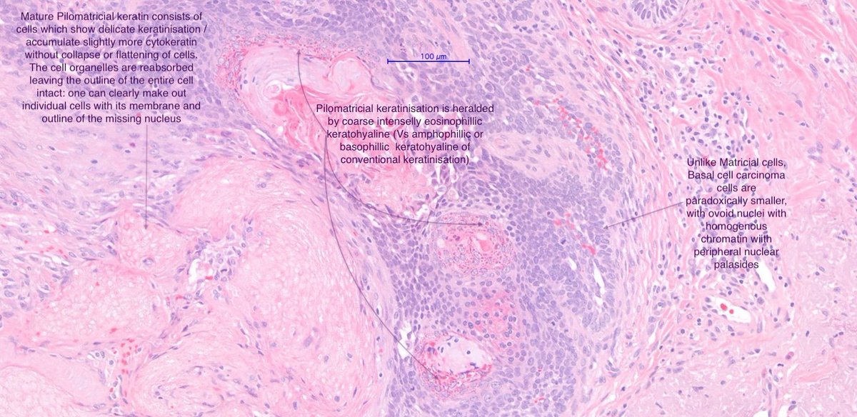 Happy Friday!

Basal cell carcinoma with Pilomatricial differentiation 🤩

#dermpath #dermtwitter #pathtwitter #pathresident #dermatologia #dermatology  #dermatologist #pathologist #histopathology #surgpath #dermatopathologia #dermatopathology #dermatopathologist