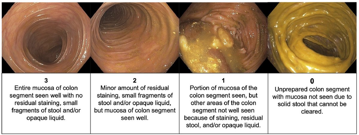 Improving #adenoma detection and resection: the role of tools, techniques and simulation-based mastery learning ow.ly/XNRv50QVMfw @VinayChandraMD