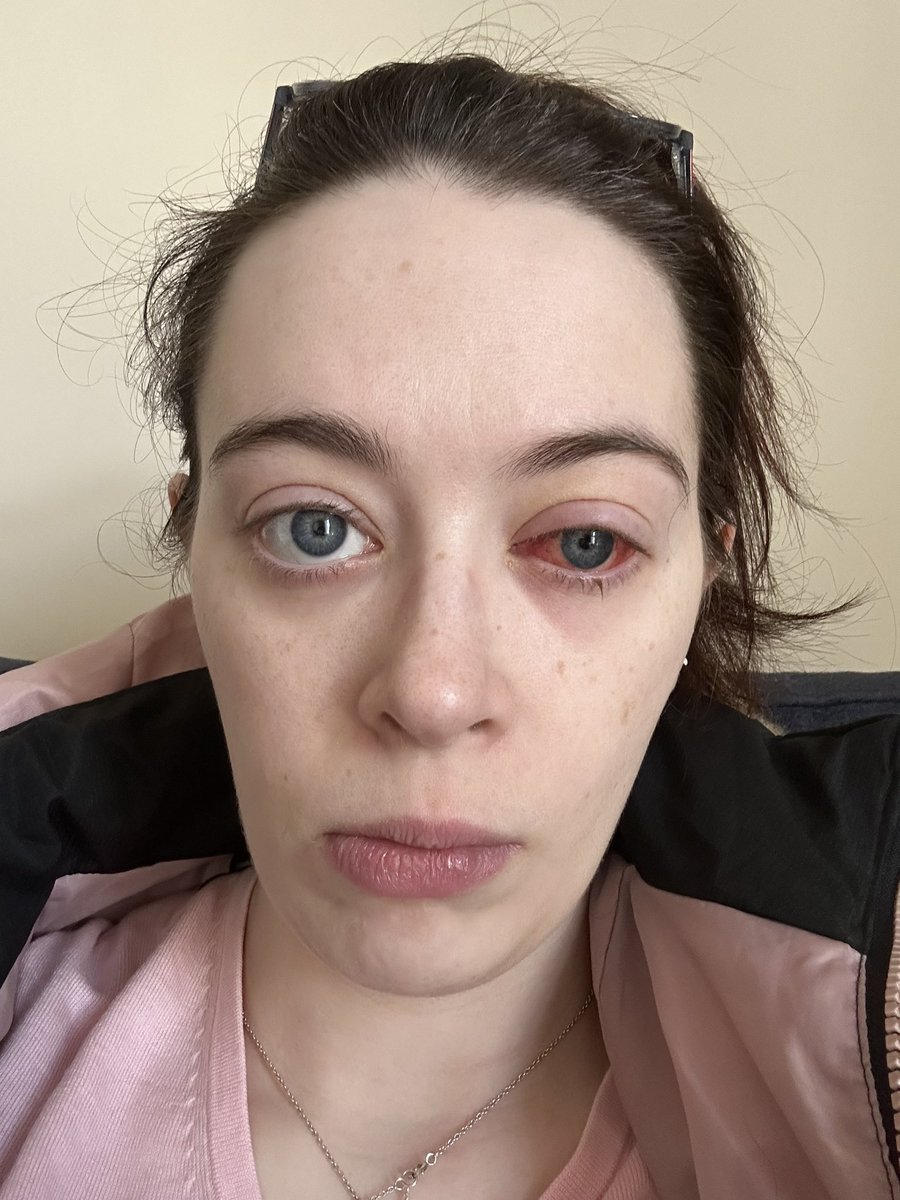I’m at the stage post squint surgery where I look like I’ve been punched in the face
