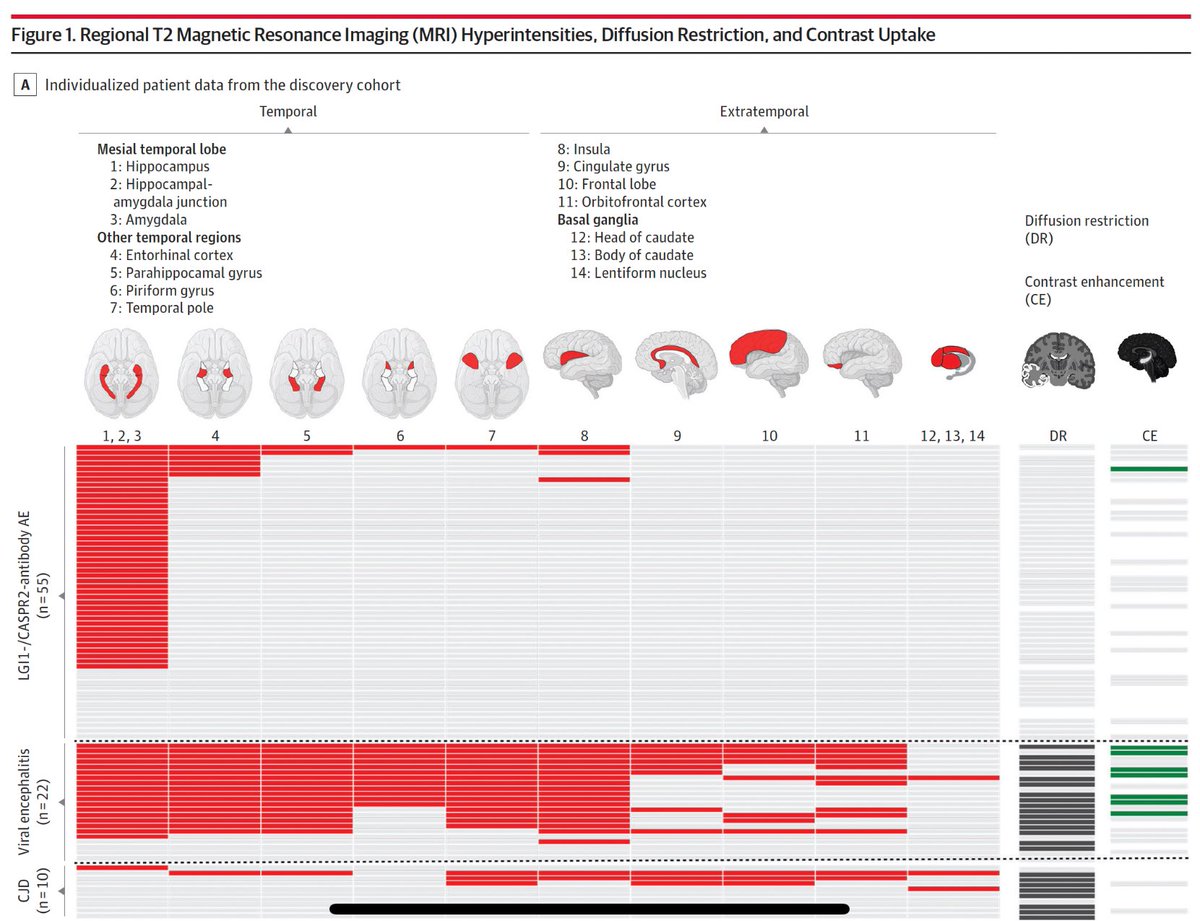 Cool to see this article out. The MRI features which we describe aim to help differentiate HSVE from #autoimmune #encephalitis and CJD. 

⭐️ Pretty striking data ☄️

Great Ox-Mayo collaboration. 
<a href="/silverbluefin/">Fintan Sheerin</a> <a href="/EoinFlanagan14/">Eoin Flanagan</a>