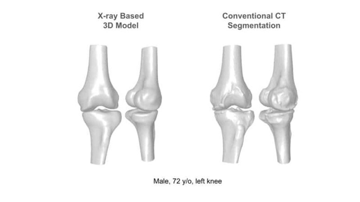 XPlan, a spinoff of @RSIPvision, confirms premier precision in peer-reviewed clinical study of its 2D-to-3D knee reconstruction solution. Learn more: surgicalroboticstechnology.com/news/xplan-ai-… #medicaldevices #healthcare #surgicalroboticstechnology