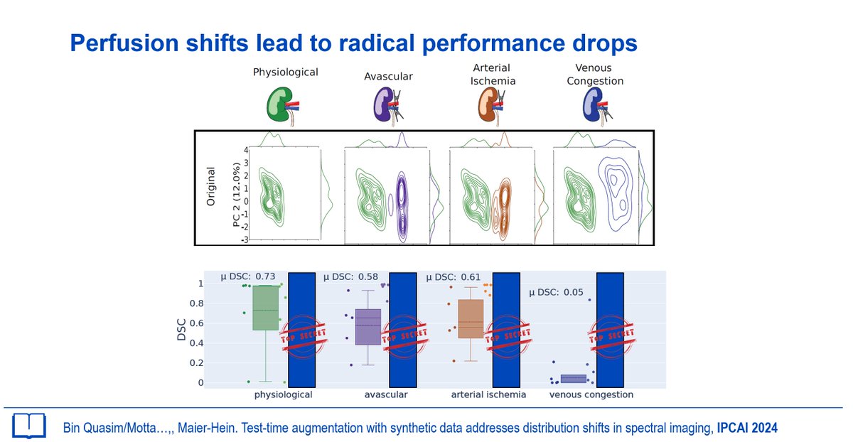 Generalization (e.g. due to rare pathologies) is a huge issue in medical imaging AI. In @ERC_Research grant #NeuralSpicing we use test-time augmentation with synthetic data to address this issue. The @IPCAI_conf paper is now available: link.springer.com/article/10.100… 1/2