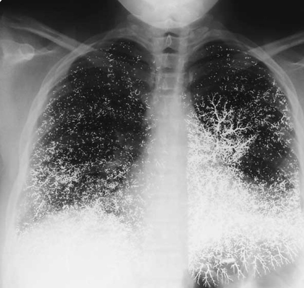 Harrowing chest radiograph shows the lungs of a 21-year-old dental nurse after she attempted suicide by injecting 10ml of elemental mercury intravenously. Miraculously, she survived.