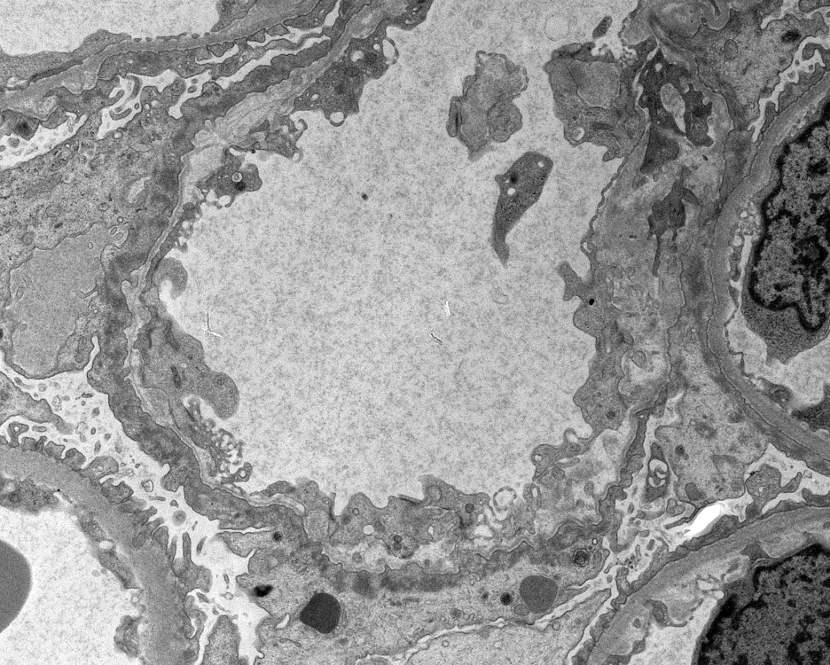JZRenalPath's tweet photo. Rare atypical "Alport-like" GBM remodeling which can be commonly seen with IgA nephropathy. These changes are usually very segmental.  #renalpath #PathTwitter https://t.co/PZMKlVQL2y