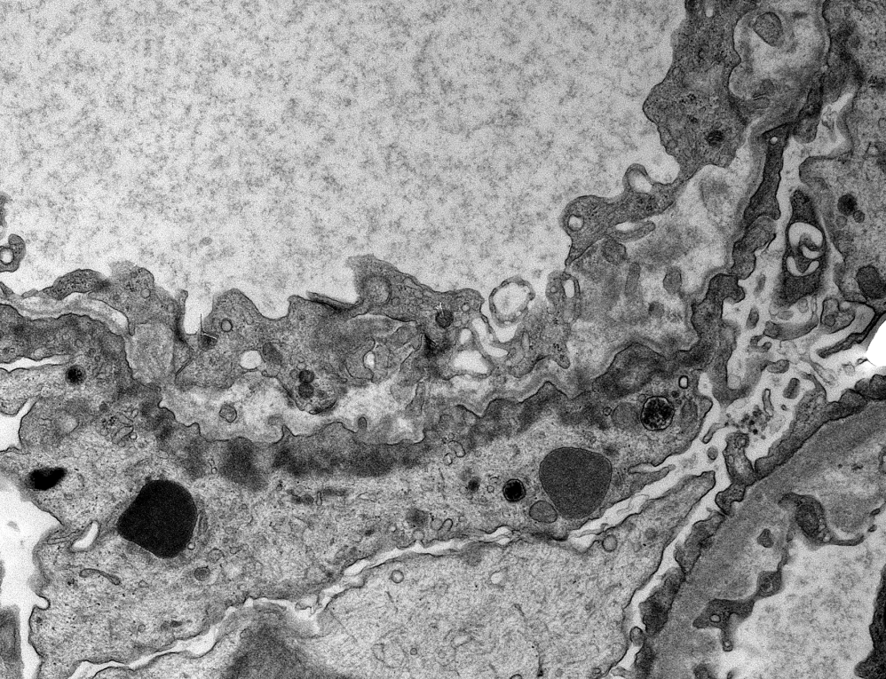 JZRenalPath's tweet photo. Rare atypical "Alport-like" GBM remodeling which can be commonly seen with IgA nephropathy. These changes are usually very segmental.  #renalpath #PathTwitter https://t.co/PZMKlVQL2y