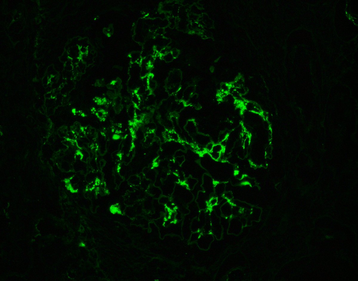 JZRenalPath's tweet photo. Rare atypical "Alport-like" GBM remodeling which can be commonly seen with IgA nephropathy. These changes are usually very segmental.  #renalpath #PathTwitter https://t.co/PZMKlVQL2y