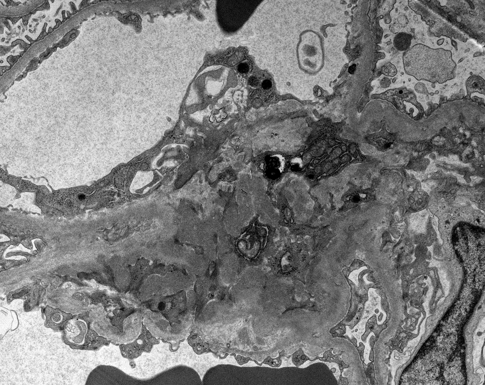 JZRenalPath's tweet photo. Rare atypical "Alport-like" GBM remodeling which can be commonly seen with IgA nephropathy. These changes are usually very segmental.  #renalpath #PathTwitter https://t.co/PZMKlVQL2y