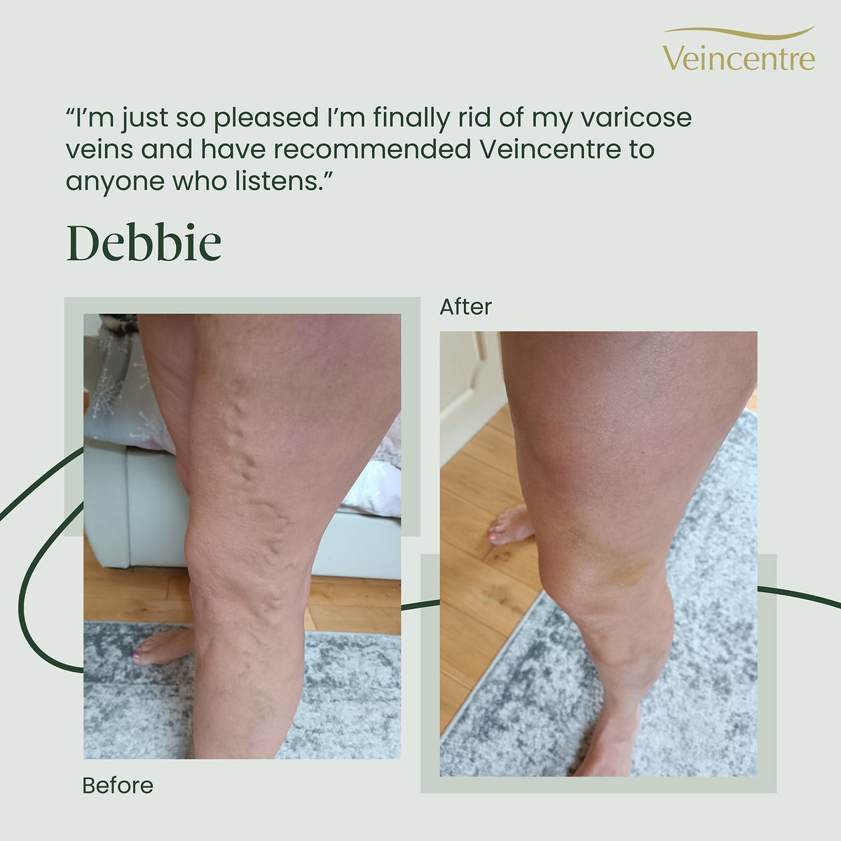 Debbie, from the North East, suffered with varicose veins for over 16 years and the unsightly appearance worsening over time gave her the push to seek treatment with us. Read more: ow.ly/GUco50QZt7l #varicoseveins #transformation #beforeandafter #resultsmatter