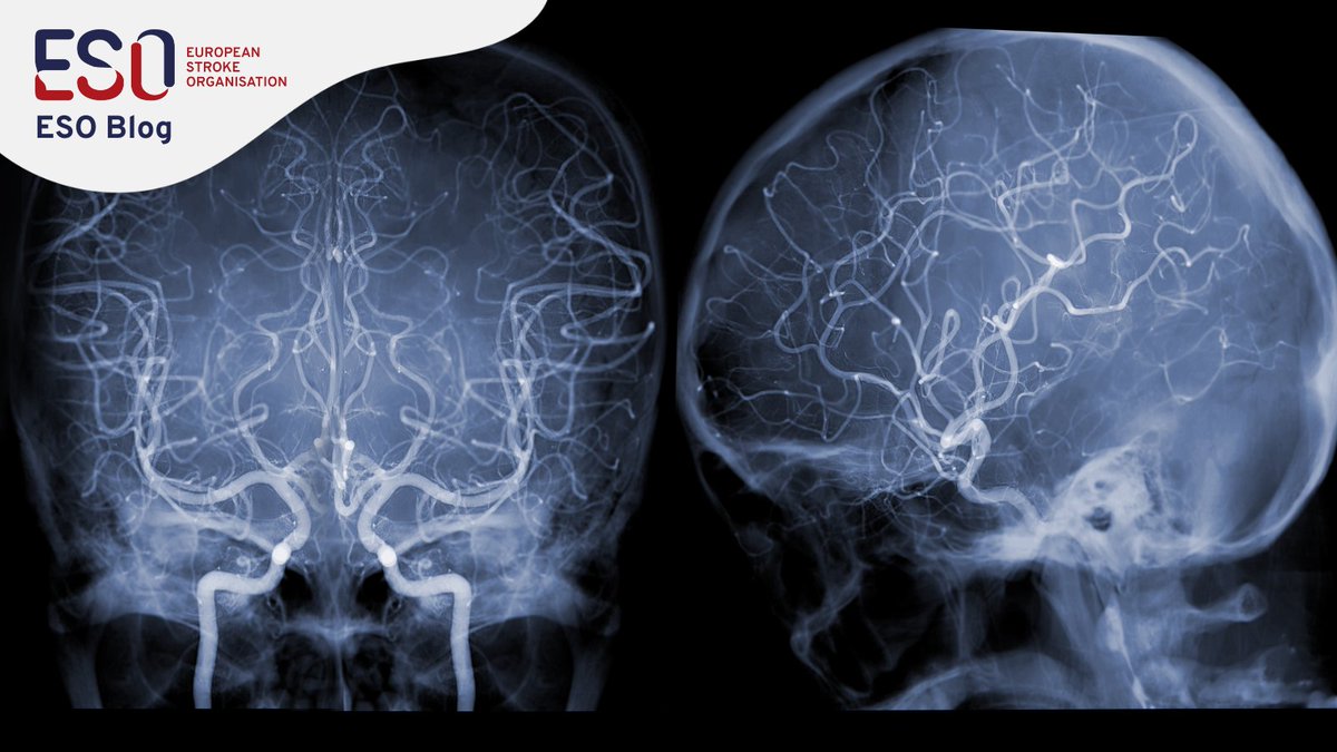 Our latest #ESOblog post: "Large Vessel Occlusion w Mild Neurological Deficits: The Dilemma", considering current ESO &amp; <a href="/American_Heart/">American Heart Association</a> &amp; <a href="/American_Stroke/">American_Stroke</a>
 guideline recommendations. ow.ly/ul1b50QYuzE
#stroke #strokeresearch #stroketreatment #stroketwitter