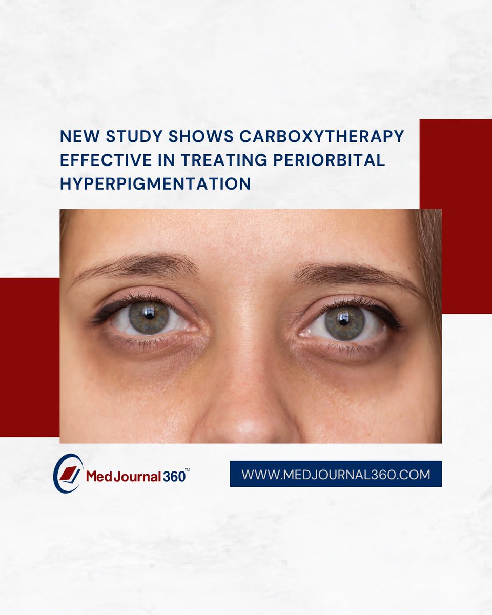 View the complete article below ⤵️
medjournal360.com/dermatology/ne…

#MedJournal360 #Dermatology #Dermatologist #Carboxytherapy #Hyperpigmentation #PeriorbitalHyperpigmentation #SkinDisease #SkinDoctor