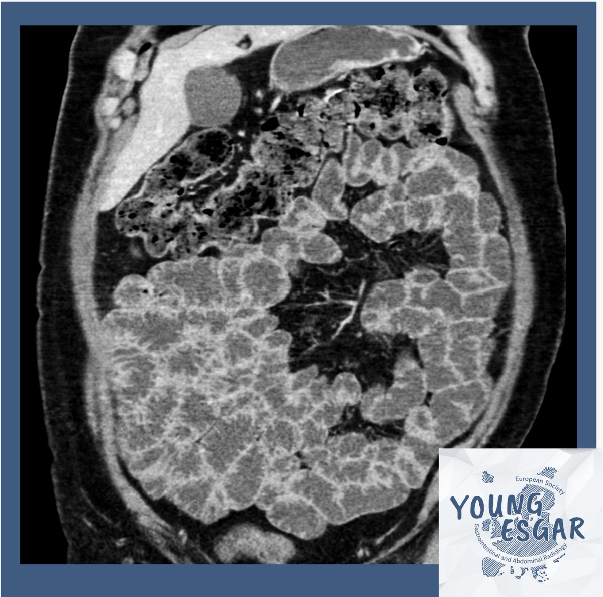 Young ESGAR quiz case! 64 Yo Male underwent CT enterography for weight loss and abdominal discomfort. Gastric and colon endoscopy negative for pathologic finding. What is the most evident small bowel sign and possible diagnosis? Comment with your answer