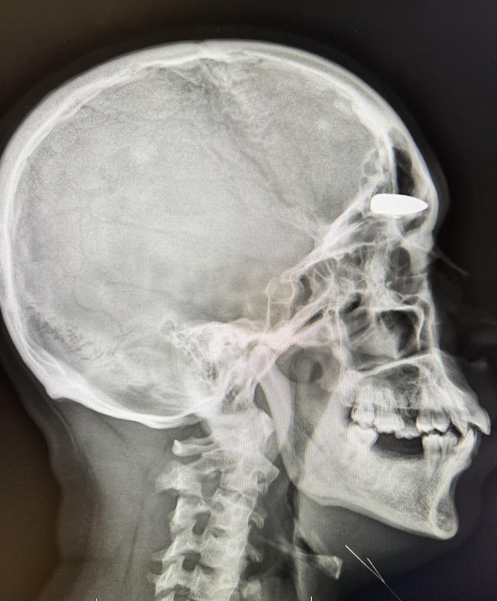 DRSHAHIDASHRAF1's tweet photo. X-ray reveals the cause of long term headaches…
#headach https://t.co/GJHhA8aT9e