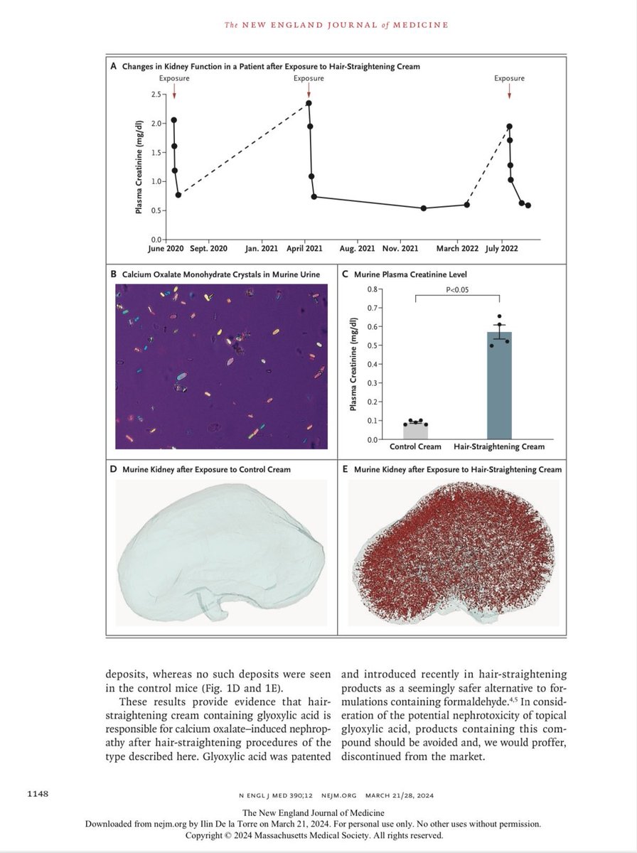 Impactante!
Mujer de 26 años sin problemas de salud, desarrolla 3 episodios consecutivos de lesión renal aguda tras tratamientos de alisado del pelo con un producto que contenía 10% de ácido glioxílico (matabolizado a oxalato). Hay más casos previos.
nejm.org/doi/full/10.10…