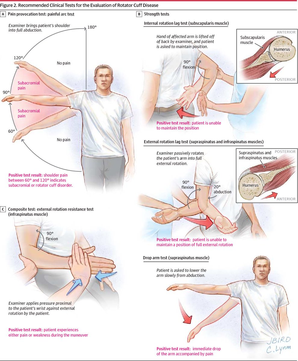 Recommended Clinical Tests for the Evaluation of Rotator Cuff Disease👇

#shoulder #rotatorcuff
pubmed.ncbi.nlm.nih.gov/23982370/