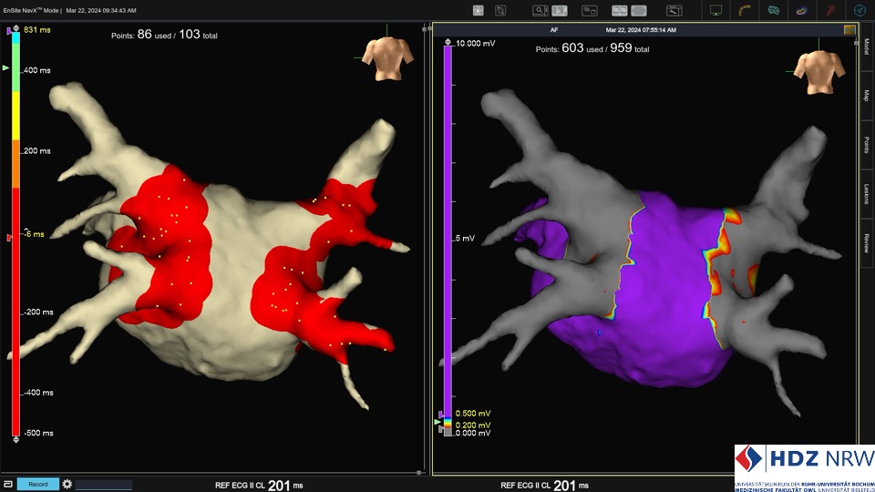 Lesion prediction using Ensite X v3.0.2. with enhanced visualization of #Farawave catheters today <a href="/HdzNrw/">HDZ NRW</a> compared to post-ablation voltage mapping. Promising improvement! <a href="/AbbottNews/">Abbott</a>