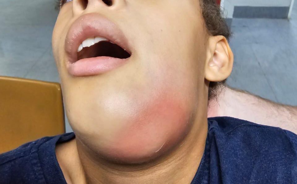 DrMahri's tweet photo. أعزائي الام و الاب حفظكم الله ، نحن نعلم كأطباء و أباء أن متابعة الابناء في تنظيف اسنانهم مهمه صعبه ولكنها والله مهمه جداً!

أكثر شي يوجع قلبي لما طفل يجيني في الطواري و عنده خراج كذا كبييير! و بالتالي يحتاج يدخل عمليات عشان ينظف له المكان ويخلع الاسنان المسؤوله عن هذا الخراج!

بلييييييييز أبنائكم أمانه في أعناقكم، أسأل الله ان يشفيهم 

الصورتين الاولى قبل العملية والصورة الاخيرة بعد العملية بيومين 

#mahri_game