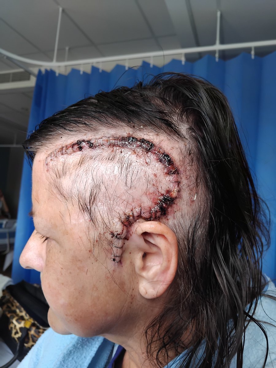 Hello all, had my surgery a week ago, still have swelling and being sore, so until the swelling has gone down, the stitches stay in. Was a big shock 😲 Need lots of hugs