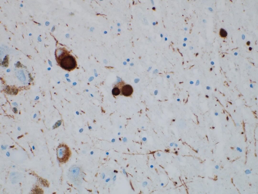 Lewy bodies! Substantia nigra, Lewy body dementia. 1. Watercolor on paper 2-3. H&E 4. Alpha-synuclein #neuropath #neuropathology #neurosurgery #neuroradiology #pathart