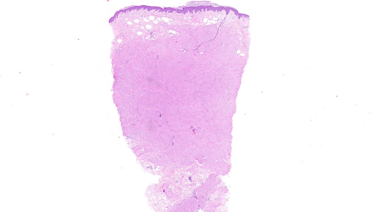 TristanRutland7's tweet photo. Skin, adult

#Dermpath #BSTpath #Pathresidents #PathTwitter https://t.co/Jg56IVtqUW