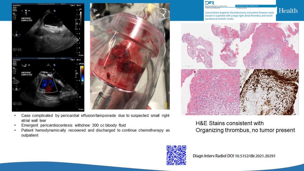 Eric H Yang, MD (@datsunian) on Twitter photo 🙏 <a href="/LYnalvez/">Leslie Ynalvez</a> & <a href="/UTHealthHouston/">UTHealth Houston</a> ♥️ fellows for the opportunity to share fascinating #cardioonc cases involving multimodality imaging & transcath interventions at <a href="/UCLAHealth/">UCLA Health</a>.
Fantastic discussion & ❓ guided by consensus documents by <a href="/CardioOnc_MR_CT/">Lauren A. Baldassarre, MD, FACC, FSCCT, FSCMR</a> <a href="/onco_cardiology/">Juan Lopez-Mattei, MD</a> et al! 1/ 🙏 <a href="/LYnalvez/">Leslie Ynalvez</a> & <a href="/UTHealthHouston/">UTHealth Houston</a> ♥️ fellows for the opportunity to share fascinating #cardioonc cases involving multimodality imaging & transcath interventions at <a href="/UCLAHealth/">UCLA Health</a>.
Fantastic discussion & ❓ guided by consensus documents by <a href="/CardioOnc_MR_CT/">Lauren A. Baldassarre, MD, FACC, FSCCT, FSCMR</a> <a href="/onco_cardiology/">Juan Lopez-Mattei, MD</a> et al! 1/