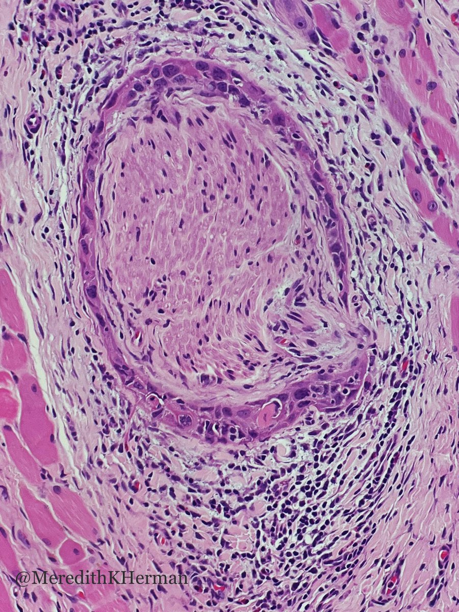Meredith Herman, DO (@meredithkherman) on Twitter photo Text book picture of perineural invasion 🔬 what cancer is encroaching this nerve?
@Tom_J_Giordano <a href="/UMichPath/">Michigan Pathology</a> <a href="/KMirza/">Kamran Mirza MD PhD - کامران مرزا</a>
#pathX #pathfigure #surgpath Text book picture of perineural invasion 🔬 what cancer is encroaching this nerve?
@Tom_J_Giordano <a href="/UMichPath/">Michigan Pathology</a> <a href="/KMirza/">Kamran Mirza MD PhD - کامران مرزا</a>
#pathX #pathfigure #surgpath