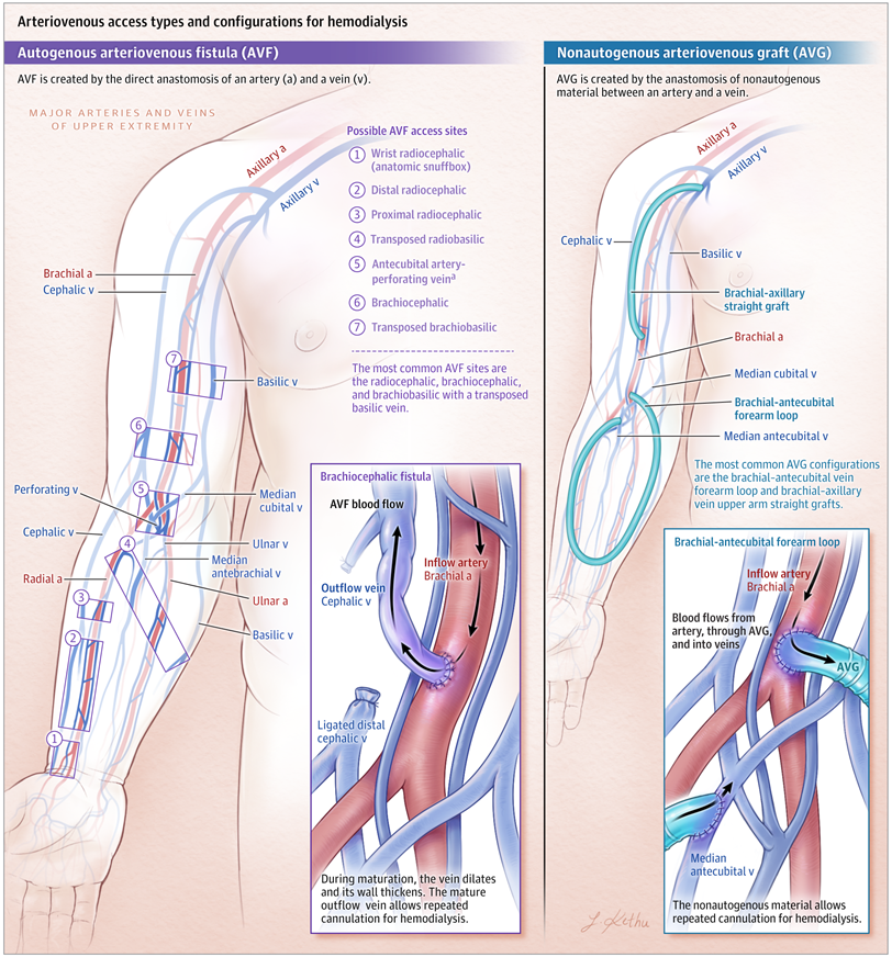 SeguraCardio's tweet photo. 📌Arteriovenous Access for #Hemodialysis
A #Review 

#CardioRenal https://t.co/ZjM78SKGw8