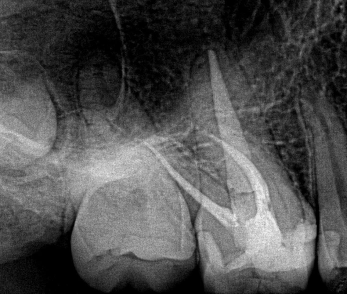 ✨ Daily cases

✨ Root canal treatment #16 

#endoresident #endowarrior #endodontic