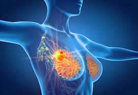 AlcoholJustice's tweet photo. Shouldn’t we know this already? The link between alcohol and breast cancer @WHO_Europe https://t.co/B0jyHyIleU  "Research indicates that even relatively low levels of alcohol consumption can contribute to the risk of developing breast cancer." https://t.co/E0y5hrZ1QH
