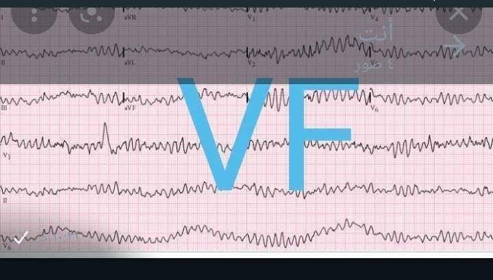 Nurse_220's tweet photo. ♦️Cardiac #arrhythmias ..

🔹تنقسم عدم انتظام ضربات القلب إلى نوعين :

♣️ bradycardia☑️
معناها المريض عدد ضربات القلب عنده اقل من 60 ضربة كل دقيقه ..

♣️ Tachycardia☑️
اما تكون عدد ضربات القلب عند المريض اكثر من 100 ضربة

🔹و تشمل :
💎Atrial fibrillation
💎Atrial flutter
💎Supra ventricular tachycardia
💎Ventricular fibrillation
💎Ventricular tachycardia