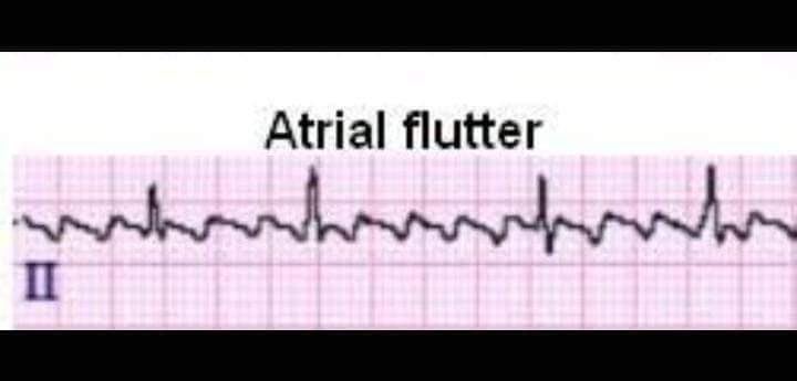 Nurse_220's tweet photo. ♦️Cardiac #arrhythmias ..

🔹تنقسم عدم انتظام ضربات القلب إلى نوعين :

♣️ bradycardia☑️
معناها المريض عدد ضربات القلب عنده اقل من 60 ضربة كل دقيقه ..

♣️ Tachycardia☑️
اما تكون عدد ضربات القلب عند المريض اكثر من 100 ضربة

🔹و تشمل :
💎Atrial fibrillation
💎Atrial flutter
💎Supra ventricular tachycardia
💎Ventricular fibrillation
💎Ventricular tachycardia