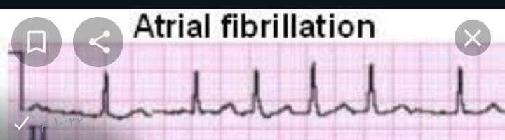Nurse_220's tweet photo. ♦️Cardiac #arrhythmias ..

🔹تنقسم عدم انتظام ضربات القلب إلى نوعين :

♣️ bradycardia☑️
معناها المريض عدد ضربات القلب عنده اقل من 60 ضربة كل دقيقه ..

♣️ Tachycardia☑️
اما تكون عدد ضربات القلب عند المريض اكثر من 100 ضربة

🔹و تشمل :
💎Atrial fibrillation
💎Atrial flutter
💎Supra ventricular tachycardia
💎Ventricular fibrillation
💎Ventricular tachycardia