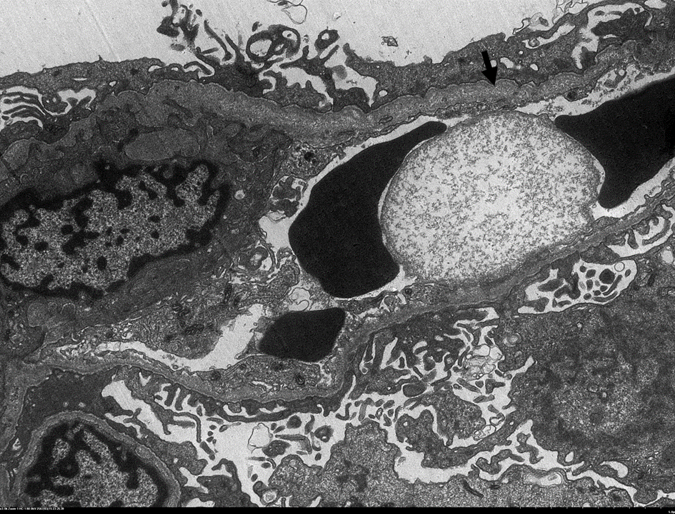 Glomerular basement membrane shows irregular thickness with lamellated or basket-weave appearance (arrows) in 12 yo F with Alport syndrome #renalpathology