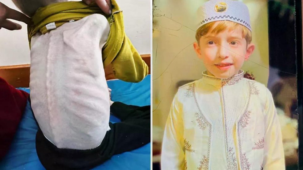 Fadi Al-Zant, a 6-year-old boy was battling malnutrition and dehydration at Kamal Adwan Hospital in northern Gaza. For months, his tiny frame endured unimaginable suffering. After countless pleas, Fadi finally found was allowed to exit Gaza into a hospital in Egypt last week. His