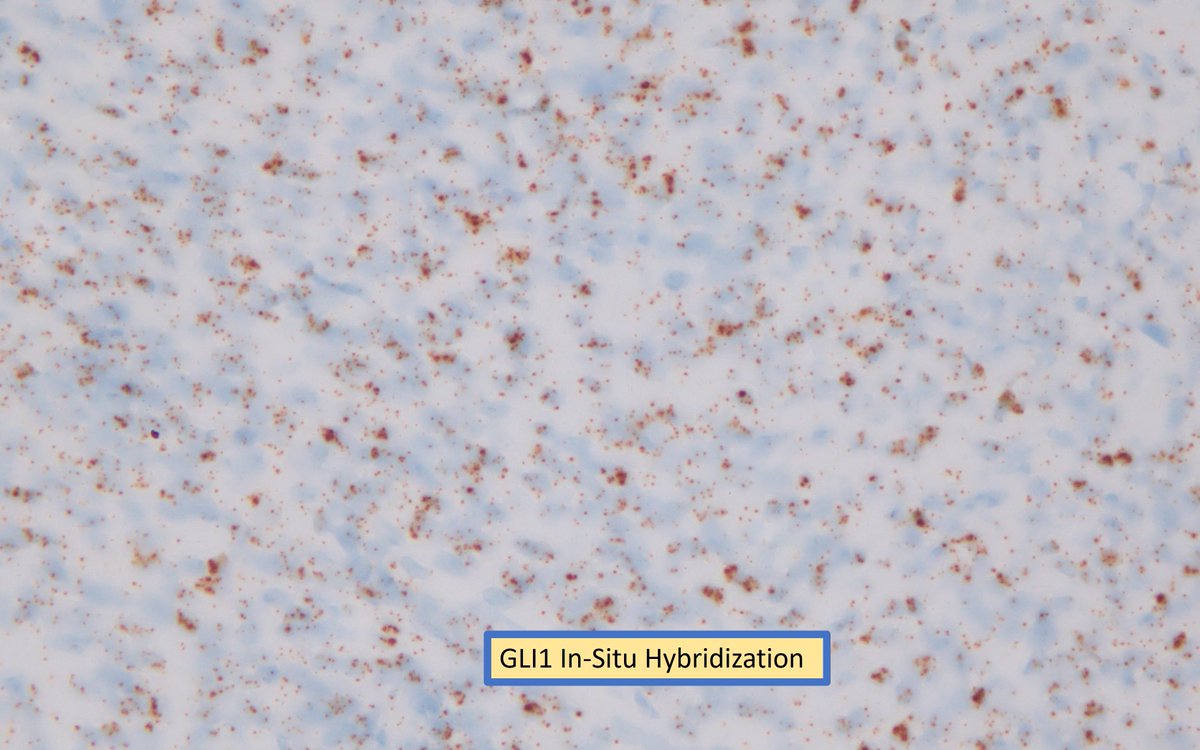 GLI1-altered mesenchymal tumor is a 'great mimicker' that can morphologically/immunohistochemically imitate many other entities. The presence of a lobular tumor with round to epithelioid cells and nests of tumor cells protruding onto vascular spaces can be a helpful hint for…