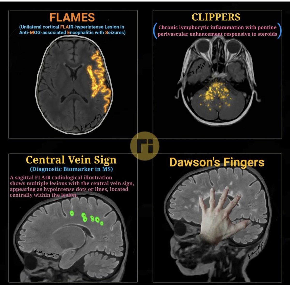 Brain signs by pediatrikradyoloji and
radiologicalillustration