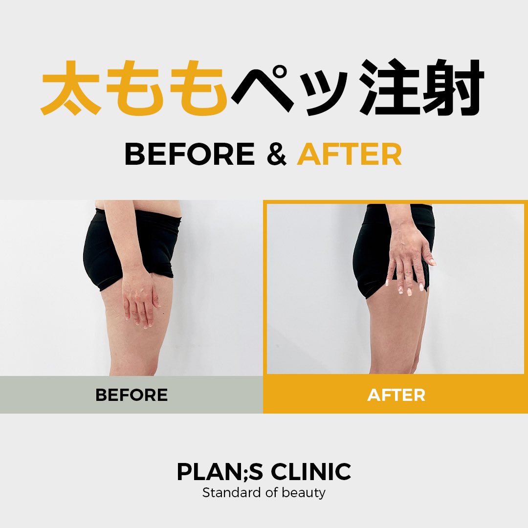 公式】プランエスクリニック（PLAN;SCLINIC／江南） on X: 