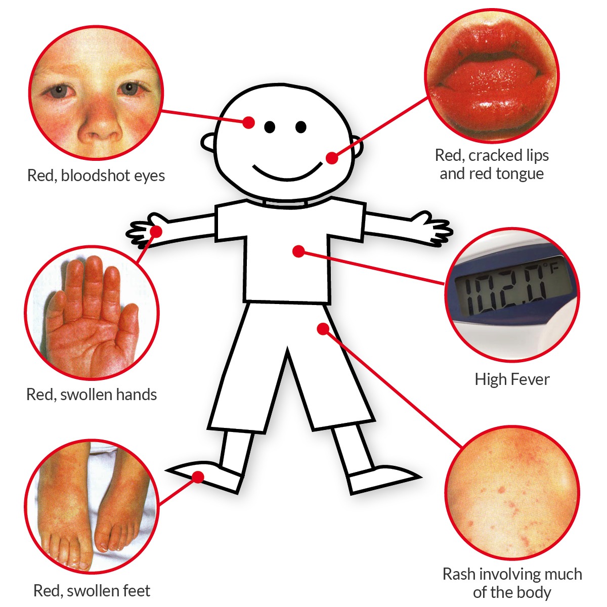 Fever Realted Rash Scarlet Fever Rash On Fingers