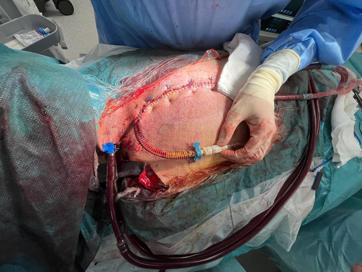 Cardiac Surgery Gregorio Marañon Hospital tweet media