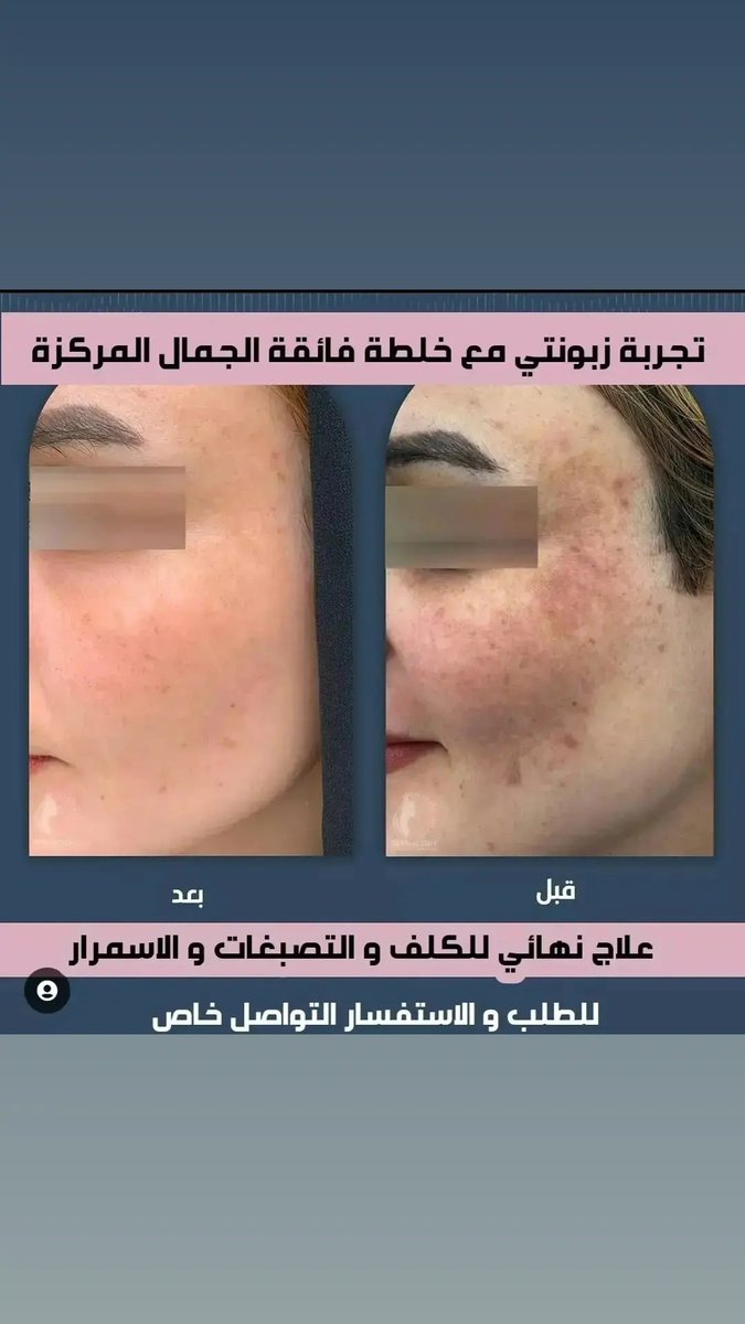 تعالي أطلبي خلطة أم سعود مع بشرة صافية تلق لق خاليه من جميع مشاكل البشرة💕💕

#السعودية#الكويت#الإمارات#عمان#قطر#البحرين#الخليج#خلطات#تفتيح_البشرة#تنحيف#عنايه#عنايه_بالبشره#عنايه_بالجسم#عنايه_بالشعر#تبييض#اهتمام#خلطات_شعر#جمال#خلطات_جسم#خلطات_عناية_تفتيح#خلطات_تبييض#اهتمامك_سر