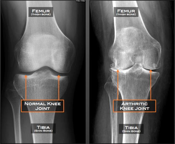 Mau share dikit, terutama buat temen2 cewek, mau bahas penyakit kerusakan sendi yang dua kali lebih sering terjadi pada wanita, dan harus dicegah sedini mungkin

Osteoarthritis(OA)

Gejalanya mulai dari nyeri lutut saat berdiri lama, kaku, bengkak, bunyi2 sendi

- Utas santai -