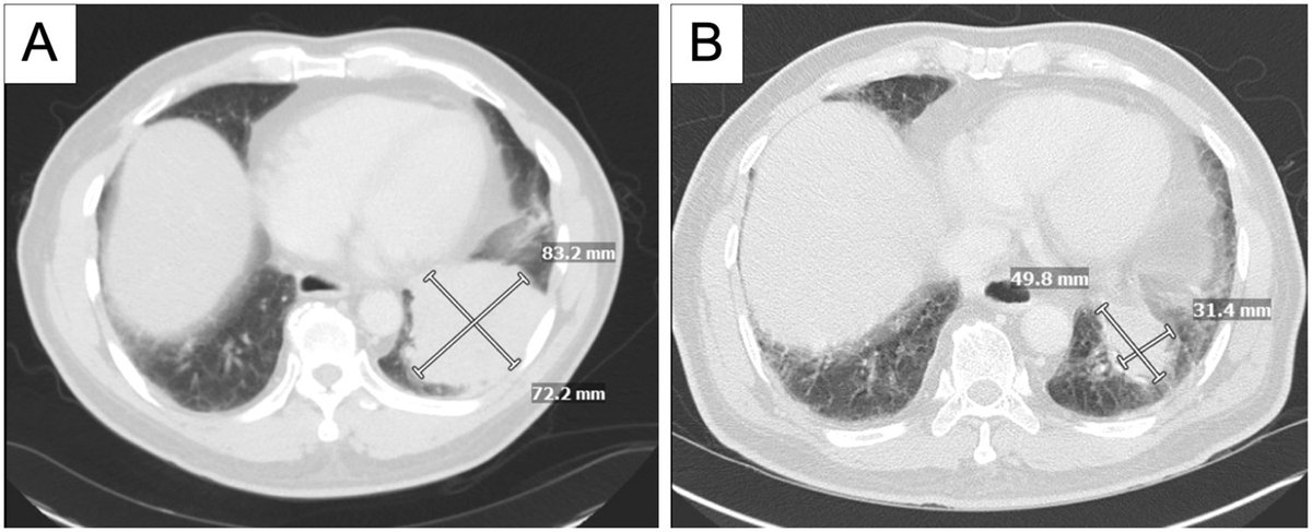 Primary pulmonary lymphoepithelial carcinoma (LEC) is a rare form of lung cancer, often associated with Epstein Barr virus (EBV) Explore a case report discussing the use of neoadjuvant chemoimmunotherapy prior to the resection of primary pulmonary LEC bit.ly/3Tu0kYG