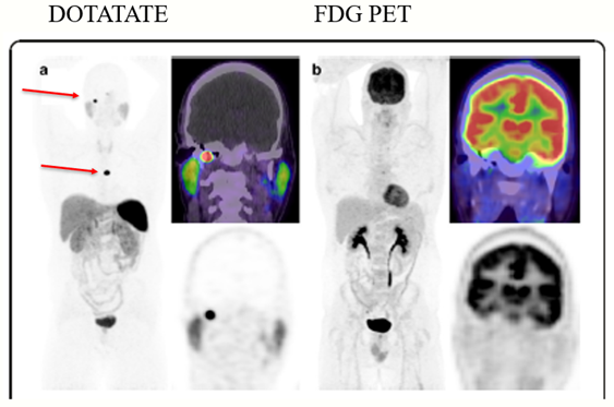 Paraganglioma week 6/6
23 patients underwent both DOTATE and FDG PET (8 also MIBG)
· Positive @ site of Dz:
   o DOTATE 96%
   o PET 91%
   o MIBG 30%
· DOTATE uptake intensity ↑↑compared to PET ӿ aggressive Dz
rdcu.be/dCdEd
