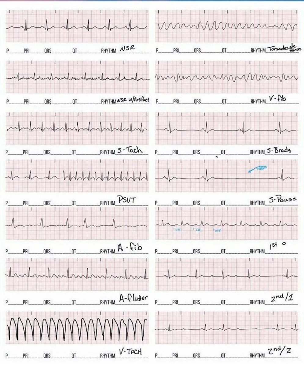 EKG rhythms to know m.e.h.d.i_sn